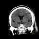Epidural hematoma, subarachoid hemorrhage, cerebral contusion, skull fissure: CT - Computed tomography